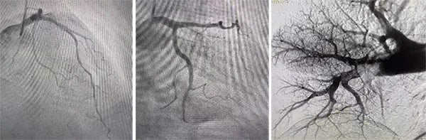 Beijing Anzhen Hospital Pioneers “Heart-Lung-Vascular Co-Treatment” Model with a One-Stop Interventional Procedure for a Critically Ill Patient
