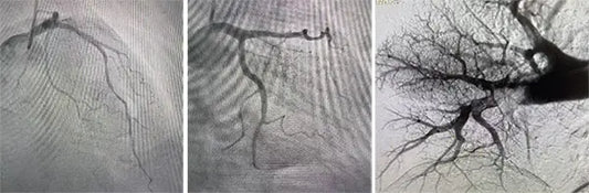 Beijing Anzhen Hospital Pioneers “Heart-Lung-Vascular Co-Treatment” Model with a One-Stop Interventional Procedure for a Critically Ill Patient