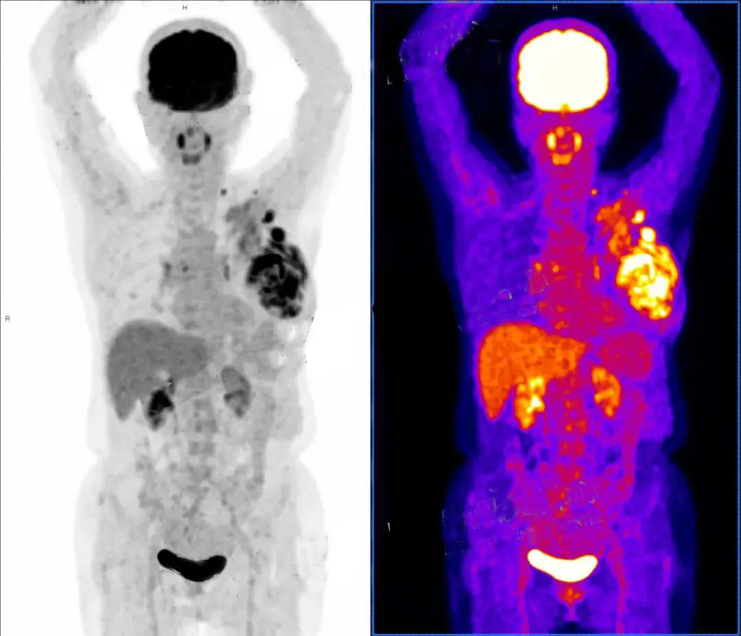 Technical White Paper: Universal Medical Standards for Precision PET/CT Staging and Multidimensional Diagnosis of Invasive Breast Cancer with Cutaneous Infiltration