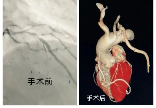 Minimally Invasive Coronary Bypass Surgery: A Revolutionary Approach to Faster Recovery