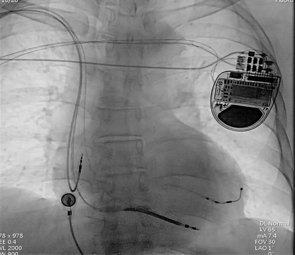Revolutionary Heart Failure Treatment: CRT-D Implantation for Complex Cardiac Patient at the Fuwai Hospital