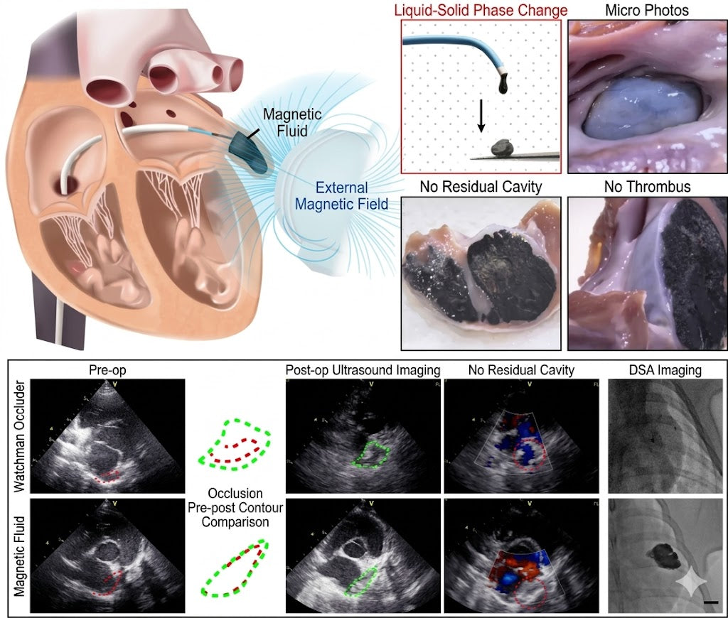 Fuwai Hospital (Beijing) Expert Team in Nature: In-vivo 3D Printing Tackles AFib Stroke Challenges